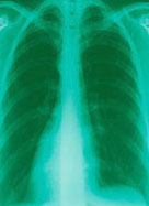 Xray of mesothelioma affected lungs